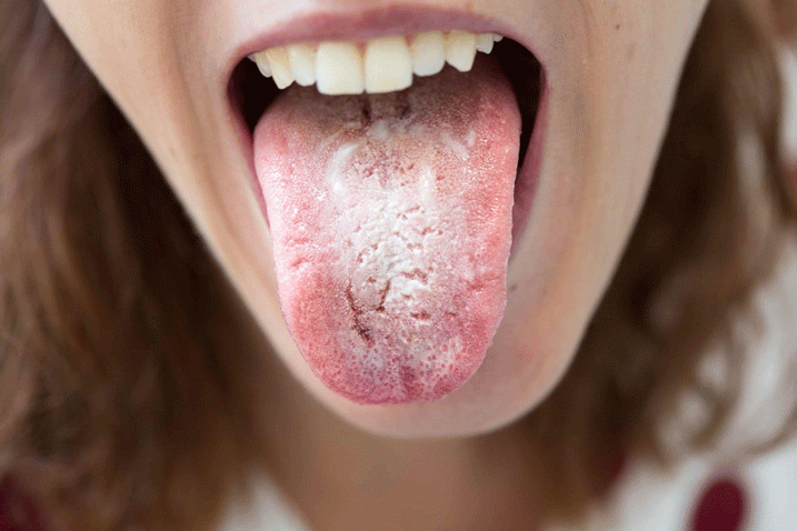 a child’s tongue with overgrowth of fungi, as a side effect of inhaled corticosteroids